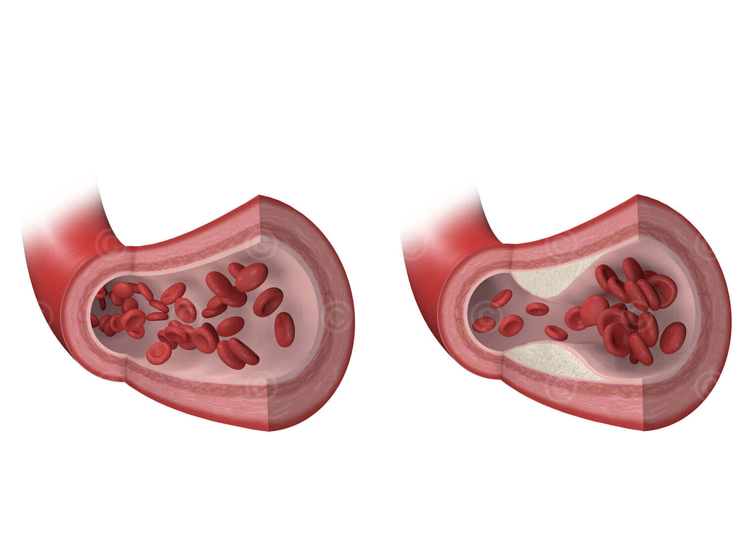 Entwicklung Arteriosklerose Medizinische Illustration und Grafik
