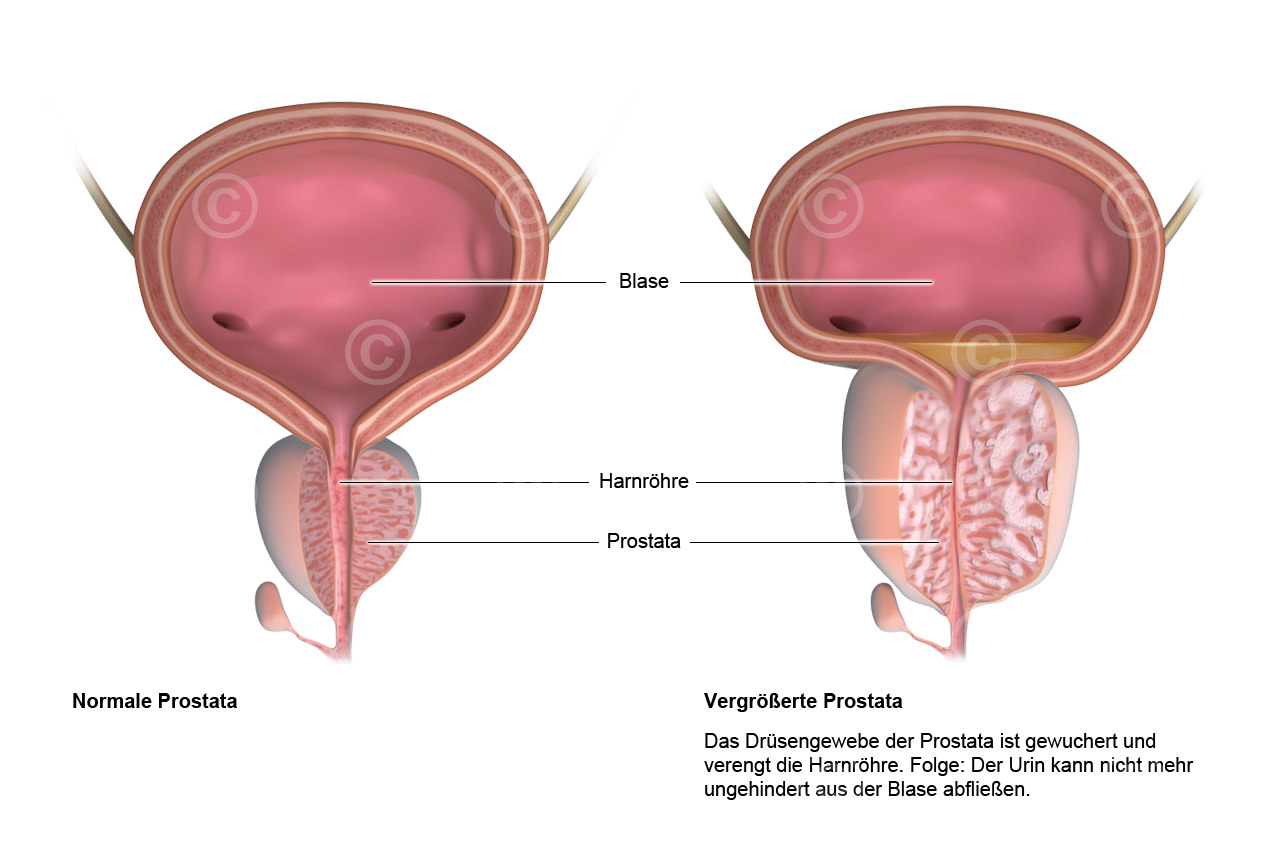Wie Sieht Eine Prostata Aus www.medizinischeillustration.de
